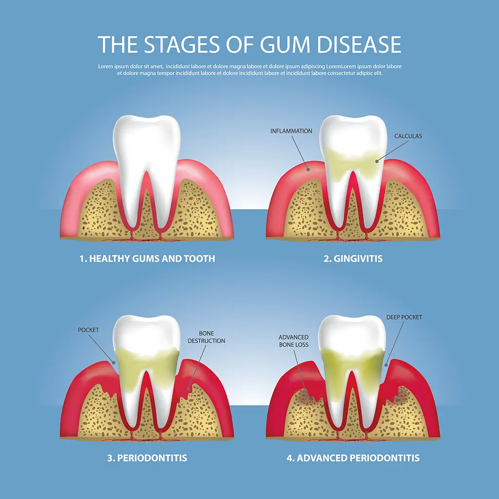 Illustration of the stages of gum disease, highlighting the progression from healthy gums to advanced periodontitis. Learn about oral health at Big Sky Family Dental.