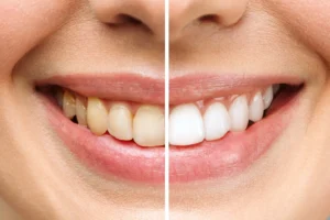 A before-and-after comparison of a smile, showcasing the significant results of teeth whitening. The left side shows teeth with discoloration, while the right side displays bright, white teeth. Big Sky Family Dental, is your trusted dental provider to transform your smile with teeth whitening.