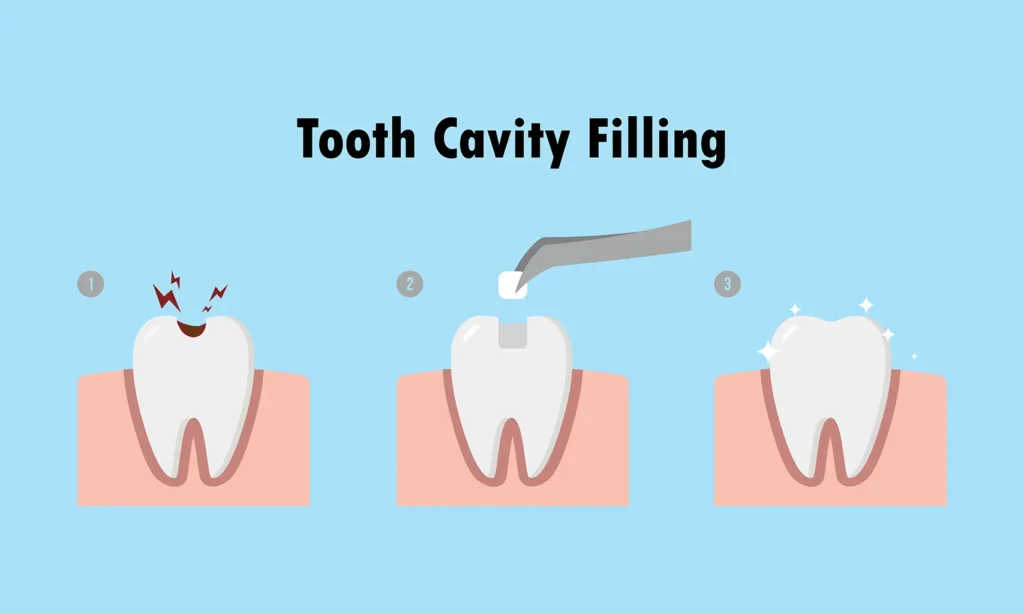 Illustration showing the stages of the dental fillings process, explaining the procedure and cost, provided by Big Sky Family Dental.