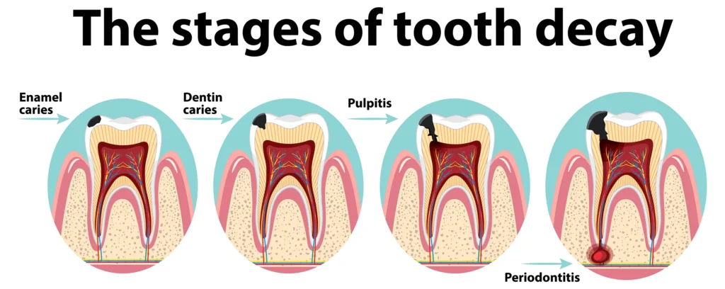 Illustration showing the stages of tooth decay, helping to understand what do cavities look like? - provided by Big Sky Family Dental.