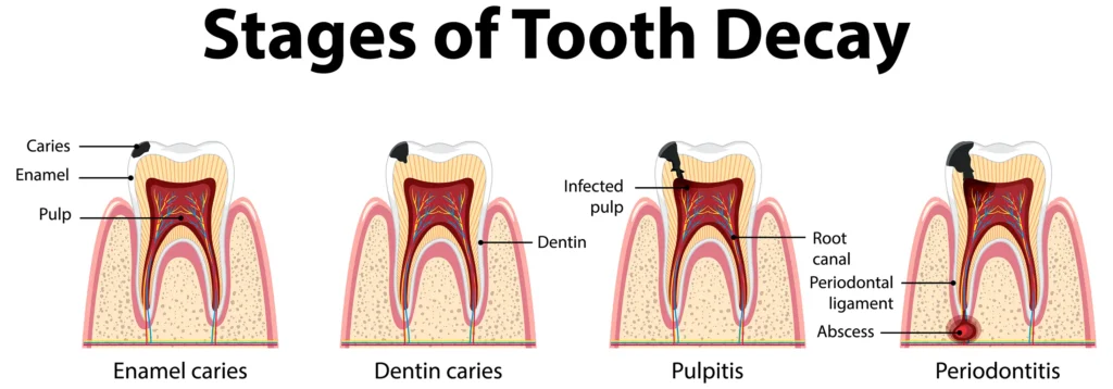 Detailed illustration showing the stages of tooth decay from enamel caries to periodontitis, provided by Big Sky Family Dental.